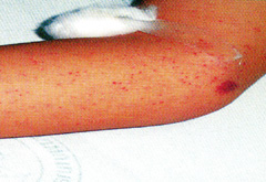 denguehemorrhagic (3).jpg